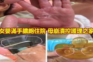 女嬰滿手膿皰住院母崩潰控護理之家