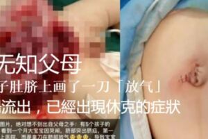 見嬰兒肚臍鼓起　父母用刀「放氣」腸流出，已經出現休克的症狀