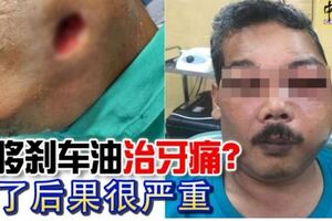 4/5/19-摩哆剎車油治牙痛？用了後果很嚴重