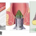 太好了，痔瘡終於有解了！教你三種方法自然消除，人人都能不再癢！只要這樣做...