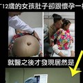 12歲女孩體內長巨大腫瘤體型瘦小腫瘤竟重30斤