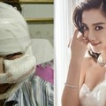 這個女的把臉整成Angelababy！還把整容過程全公開...大家都嚇到了！