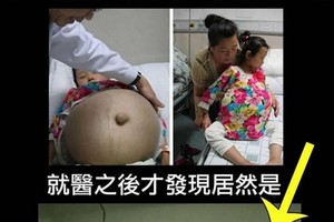 12歲女孩體內長巨大腫瘤體型瘦小腫瘤竟重30斤