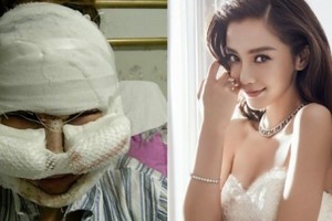 這個女的把臉整成Angelababy！還把整容過程全公開...大家都嚇到了！