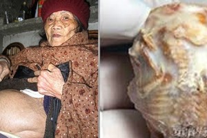 90歲老婆婆一直以為的「腫瘤」，直到看病才發現是子宮裡藏了驚人生物！沒想到醫生竟然因為這樣不願替他切除...