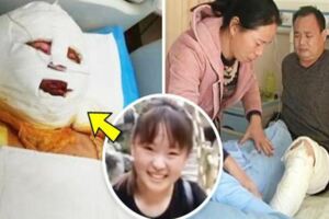 父愛如山！少女遭火吻「全身80%燒傷」，父親偷偷「移植整條左腿皮膚」卻謊稱「在外工作」！