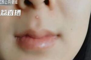 面部「危險三角區」一定要知道！女子擠這邊痘痘引發重度感染，大小便失禁還被送進加護病房