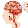 腦出血來臨，睡覺先知道？醫生提示：睡覺出現4種異常，儘早檢查