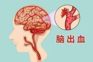 腦出血怎麼辦？醫生教你：學會這幾個急救方法能救你命