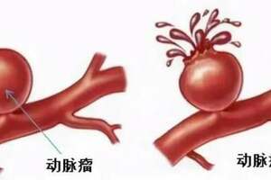 嘣！血管上的「炸彈」爆了，專家：這個年齡是道坎