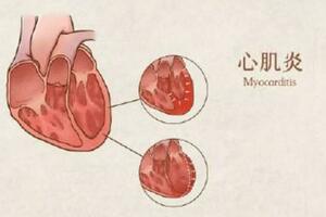 如何避免病毒性心肌炎侵襲？