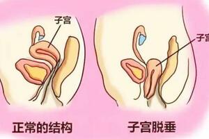 「子宮脫垂」是什麼病？主要原因是什麼？女性不要羞於了解