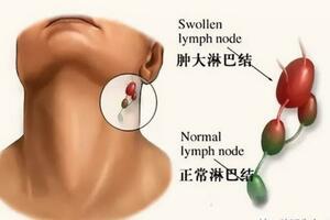 淋巴結腫了，是淋巴瘤嗎？摸到這樣的淋巴結必須要警惕！