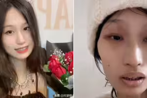 抗癌2年才知誤診！21歲正妹女大生剩32公斤　想活下來只能截肢
