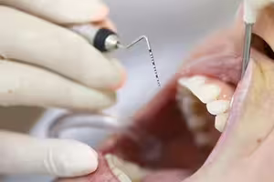 蛀牙會傳染!醫認了「情侶病」真的存在 網驚:禿頭也會 蛀牙會傳染!醫認了「情侶病」真的存在 網驚:禿頭也會