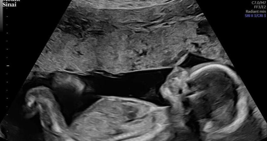 廣告小妹生了！「走過胎停的痛」平安迎來水瓶寶寶 恭喜當媽媽成就解鎖