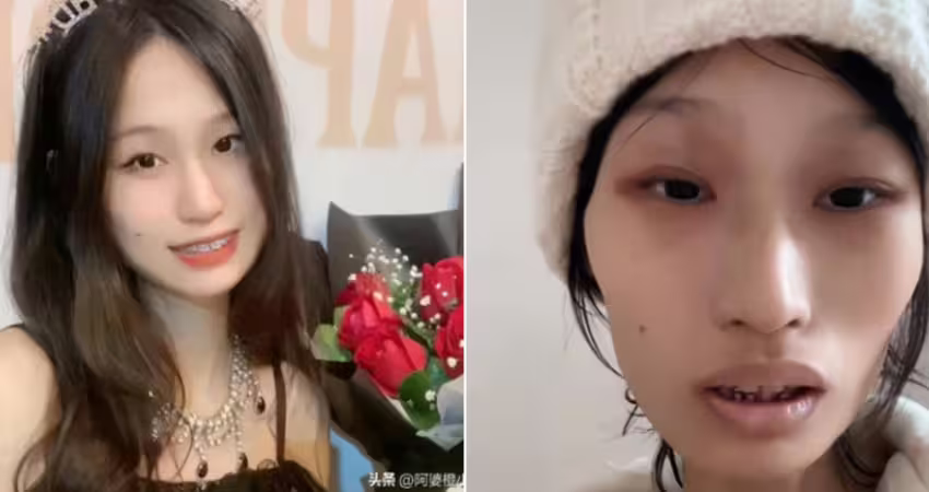 抗癌2年才知誤診！21歲正妹女大生剩32公斤　想活下來只能截肢