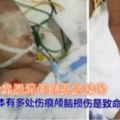 心痛！1歲女童疑遭母親男友虐待，生還可能為零！嫌疑人被刑拘！