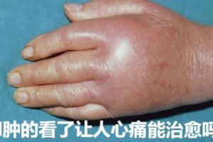 痛風能治癒嗎？痛風如何預防？吃出來的「富貴病」