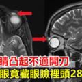 女子眼睛凸起不適開刀隱眼竟藏眼瞼裡頭28年