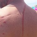男子去海邊玩卻被「鯊魚狠狠撞了背部」一下，回去後劇痛難耐入院！給醫生檢查後「發現的原因」，讓他寧願當時被鯊魚吃掉！