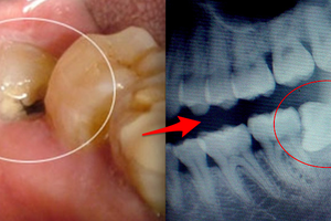 千萬不要再「不拔智齒」了，90%的人全搞錯了！這些人長年沒拔智齒，沒想到口腔最後竟然...太可怕了！