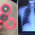 10歲女孩玩指尖陀螺「玩到吞進喉嚨」，媽媽看了X光照差點就暈倒在醫院裡！