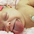 小女嬰因為出生就有「比嘴巴大兩倍的舌頭」而差點窒息而死，經過醫生的全力醫冶後，看到她現在露出可愛的笑容，真讓人安慰！