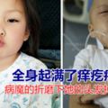 5歲女孩患白血病面目全非，身起滿了癢疙瘩，對媽媽說我不想死