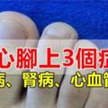 肝病、腎病、血管疾病看腳就知道，腳上出現3個症狀，要小心了