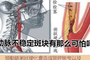 動脈不穩定斑塊有那麼可怕嗎？經常聽身邊人說起，頸動脈，冠狀動脈有不穩定斑塊