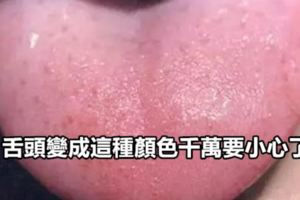 舌頭變成這種顏色千萬要小心了