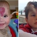 男童出生就「長血管瘤」毀了整張臉，醫生替他手術卻「變成惡魔角」！最後模樣讓爸媽激動落淚！