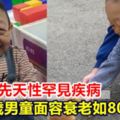 鼻酸！先天性罕見疾病6歲男童面容衰老如80歲