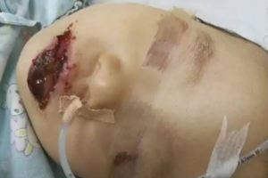 2歲女童誤將清潔劑當成奶粉吃口唇發黑糜爛滲出血…