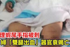 處理蝦尾手指被刺婦「雙腿出血」器官衰竭亡