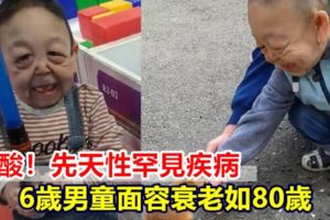 鼻酸！先天性罕見疾病6歲男童面容衰老如80歲
