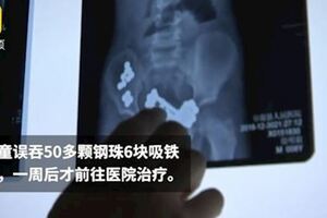 玩爸健身器材！8歲童誤吞50顆鋼珠