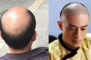 清朝一律要留辮子，那禿頂和光頭的人怎麼辦？