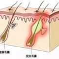 不到1塊錢的食鹽竟然是祛痘秘方！！！太厲害了！