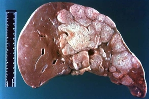 太可怕了！為何「肝癌」一發現就是晚期？你的肝若出現這些狀況，就出事了...絕對要注意！！