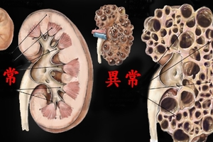 醫生叮嚀改掉這「7種習慣」他不聽，結果「腎臟」竟變成...快看你有沒有？！