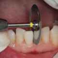 牙齒快爛了！拔牙還是補牙？已嚴重蛀牙，得根管治療做個牙套保護了