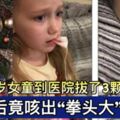 英國5歲女童到醫院拔了3顆牙齒，回家後竟咳出「拳頭大」的血塊!