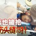 外勞也被搶遭砍傷頭縫15針!