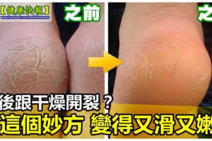 腳後跟乾燥開裂起皮怎麼辦？用幾個小妙方，讓你腳丫變得又滑又嫩！