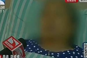 「注意」婆婆天天吃它，長出806顆膽結石！很多人都愛吃...