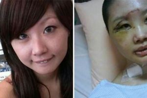 嫩妹酒駕自撞「腫成豬頭」男友嫌醜跟人跑，恢復後發表勸世文…連小三都忍不住按讚！