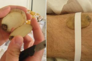 9個看似沒邏輯卻很有用的「偏方治療法」，沒想到馬鈴薯貼身上竟有這種神奇功效！