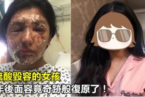 被硫酸毀容的女孩，一年後面容竟奇跡般復原了！